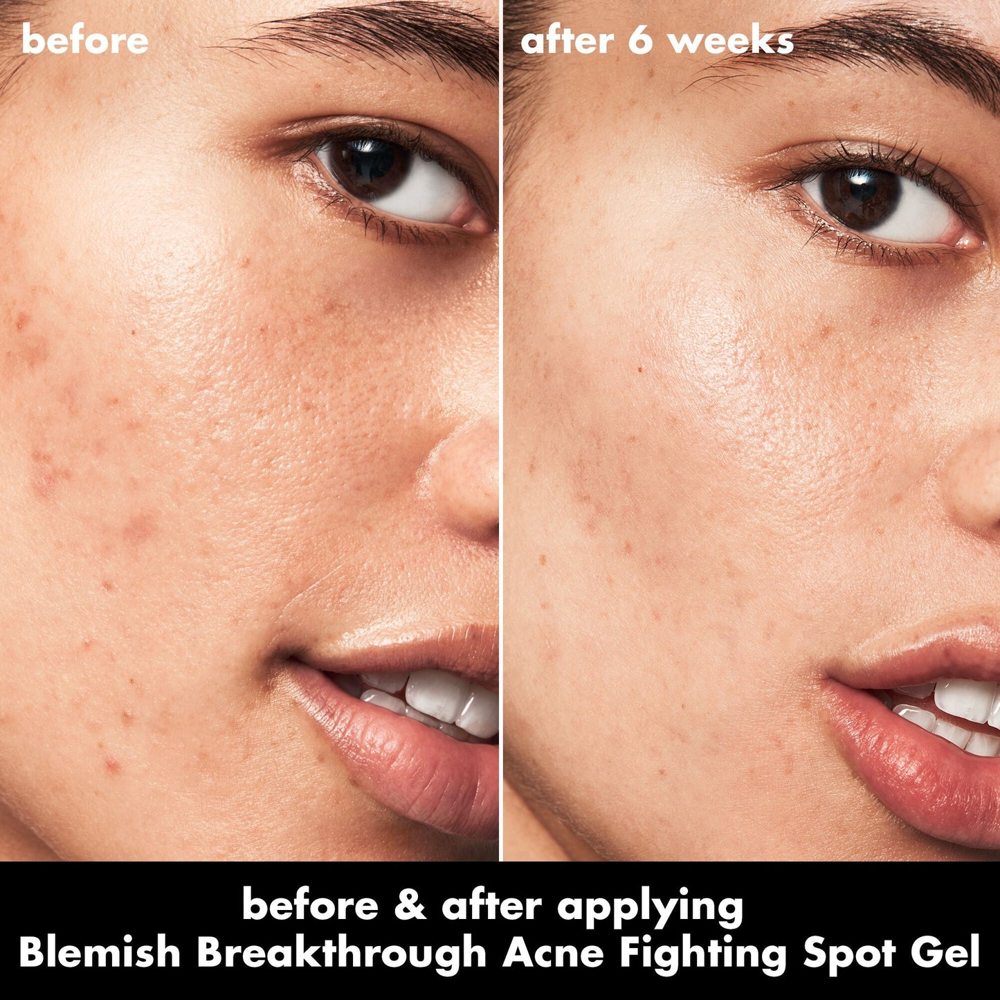 blemish-breakthrough-acne-fighting-spot-gel-j6 0326_EDU_BB_SpotGel_BA_ISABELLA.jpg