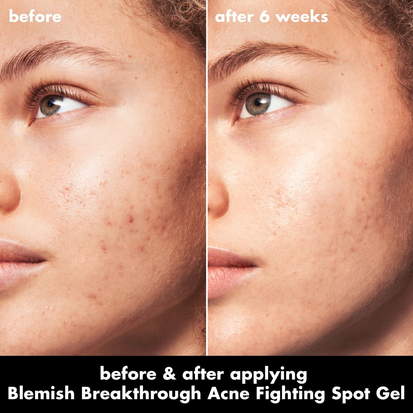 blemish-breakthrough-acne-fighting-spot-gel-j6 0326_EDU_BB_SpotGel_BA_MARLEY.jpg