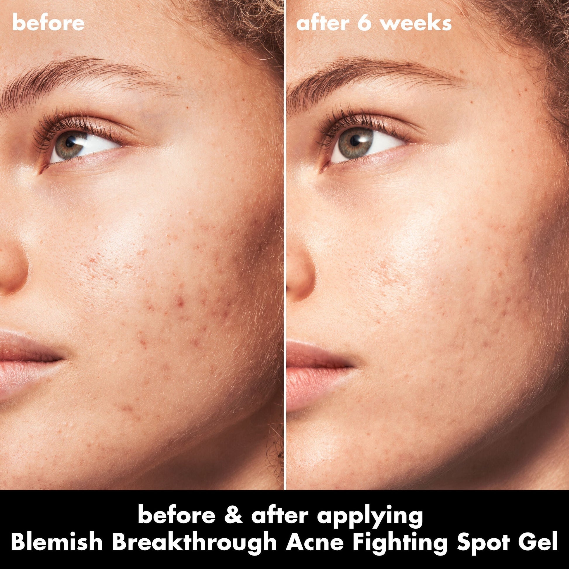 blemish-breakthrough-acne-fighting-spot-gel-j6 0326_EDU_BB_SpotGel_BA_MARLEY.jpg