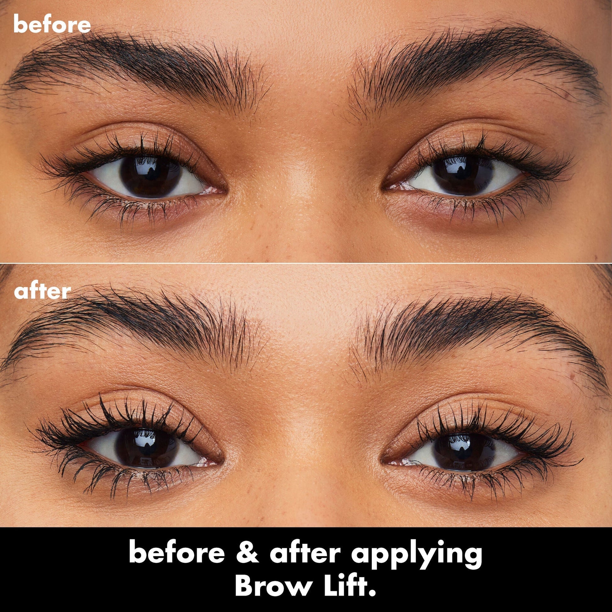 brow-lift-j5 0326_EDU_BrowLift_BA.jpg