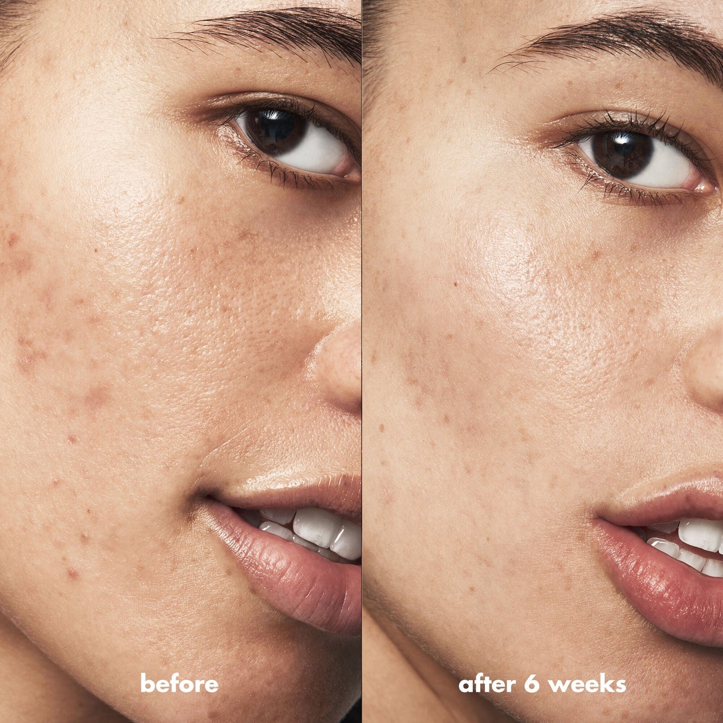 blemish-breakthrough-blemish-control-basics-kit-r9 Acne_PDP_Isabella_Before_After_0fcb9356-ae60-4e94-8953-6b1b2219dc49.jpg