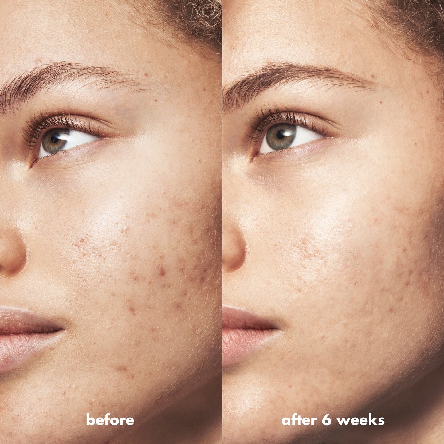 blemish-breakthrough-triple-acid-resurfacing-serum-f6 Acne_PDP_Marley_Before_After_1a95cac5-0af6-43b6-a936-d0bacbdec0bf.jpg